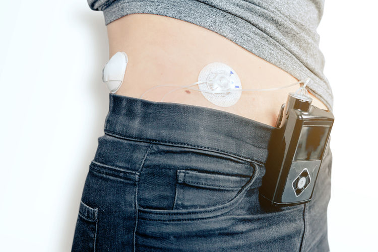Close up of a female diabetic patient with infusion insulin pump connected on the belly