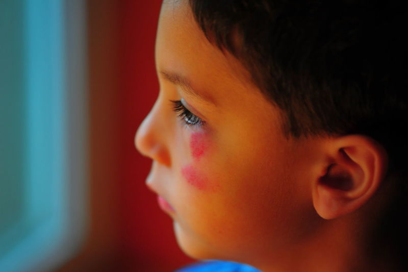 Close-up of boy with scars on face at home