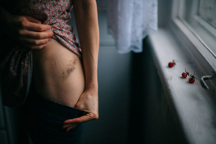 We be of one blood, thou and I Woman Berry Bruise Close-up Curtain Day Indoors Injury Lifestyles Midsection People Real People Standing Window Sill Press For Progress #NotYourCliche Love Letter