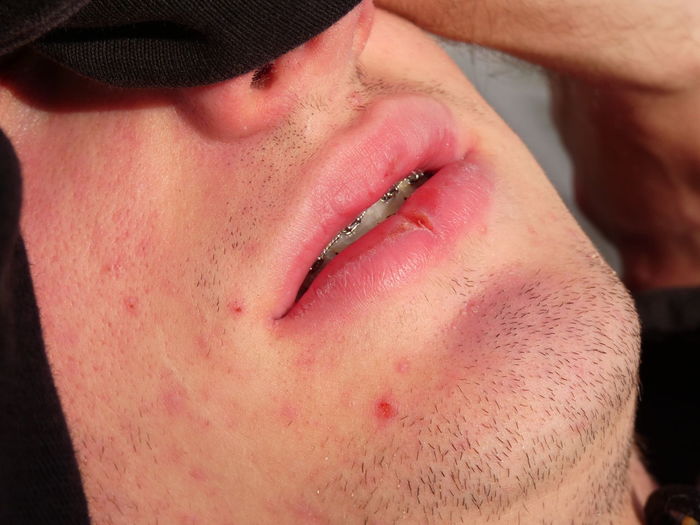 Close-up of boy with acne on face