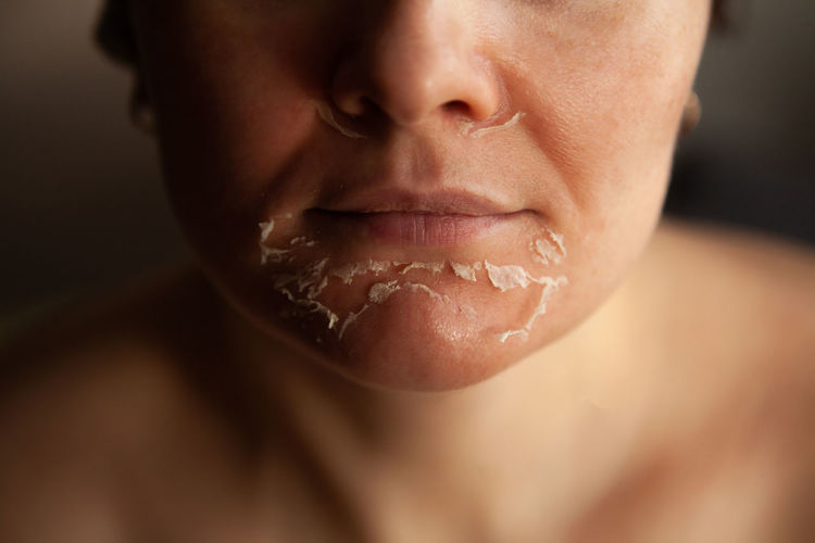 Woman's face after chemical peeling. peeling skin on the face. exfoliation of old skin. facial