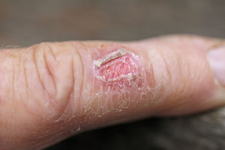 Close-up of wound on hand