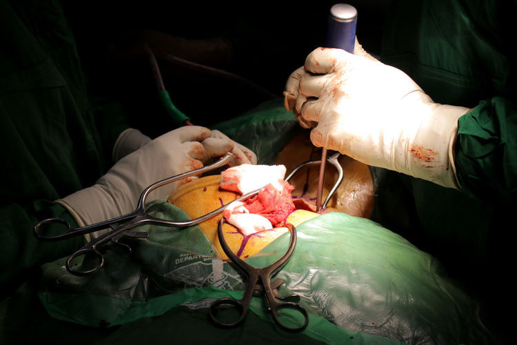 Cropped image of surgeons operating patient in emergency room