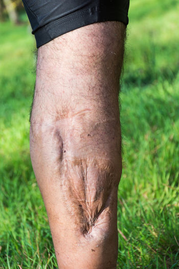 Close-up of man with injured leg