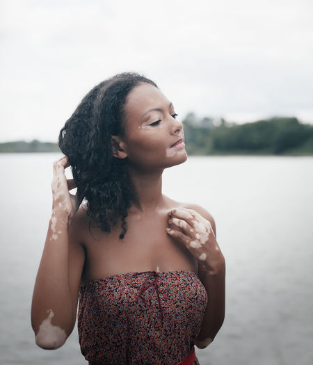 Woman suffering from vitiligo standing against lake