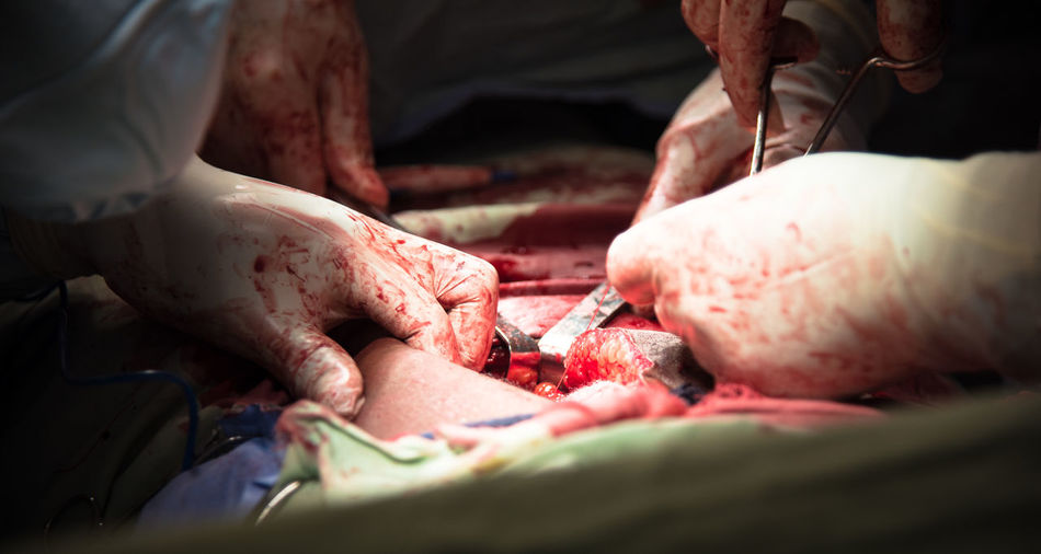 Cropped image of surgeons performing surgery