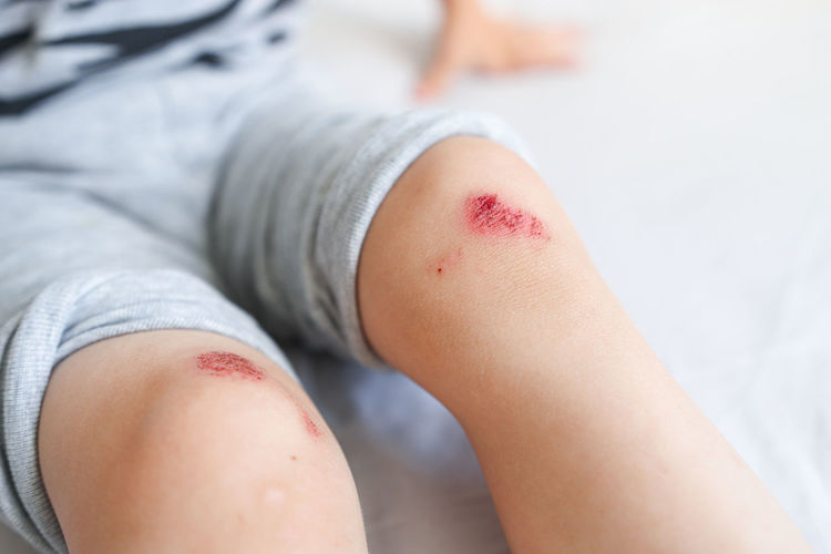 Child's leg injury close-up. the kid hurt his knee when he fell. dried blood and scratched skin.