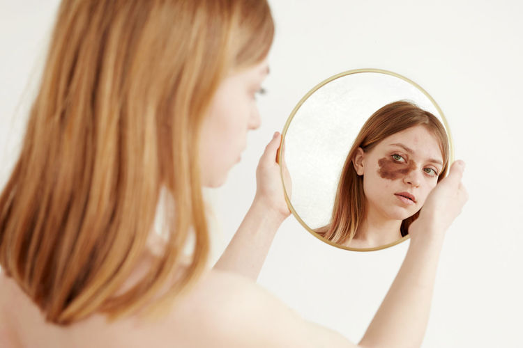 Young woman looking at mirror with birthmark on face