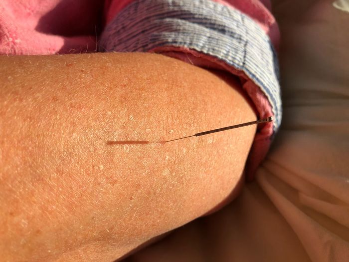 Close-up of acupuncture needle on human leg